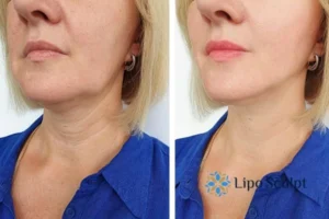 Double chin before and after Hi-Fu treatment 4 Book your double chin treatment Hertford today! We are here to help!