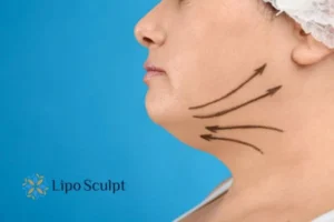 Double chin before and after Hi-Fu treatment 3 Boost your confidence with a Double chin treatment Hertford