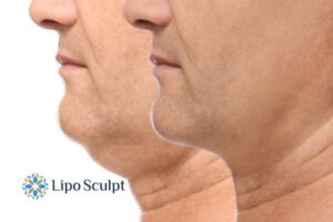 Double chin before and after Hi-Fu treatment 2 Double chin treatment Hertford from Lipo Sculpt - feel more confident today!