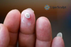 Cryopen Top 5 Treatable Conditions 4 Do you have a persistent wart of verruca that you cannot shit? Cryopen Hertford treatment will work call us NOW!