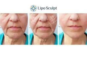 Explaining Morpheus8 And What It Can Do For You 3 Boost your confidence with Morpheus8 Hertford call our team today!