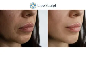 Explaining Morpheus8 And What It Can Do For You 4 Morpheus8 Hertford the best results - call our team today!
