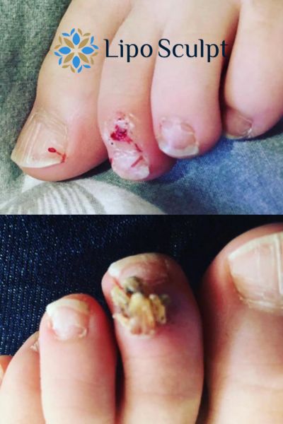 Wart removal customer results from Lipo Sculpt Hertford