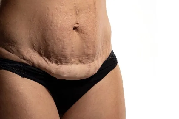 Lost the Weight but Not the Loose Skin? 1 image of womans stomach after weight loss showing loose skin Hertford